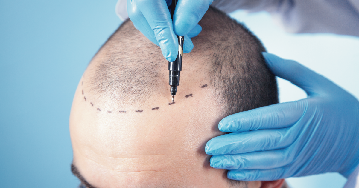 Implantes de pelo en Medellín