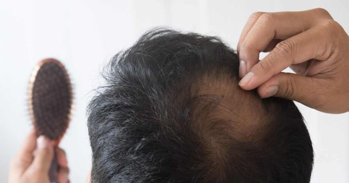 Tratamientos para caída del pelo en Medellín