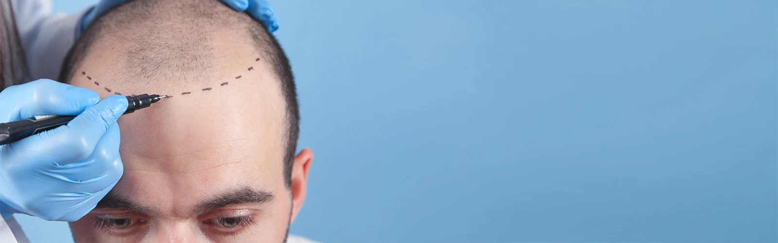 Injerto capilar Medellín